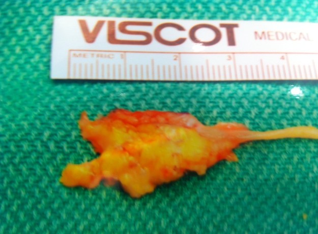 morton neuroma, neuroma surgery specimen.